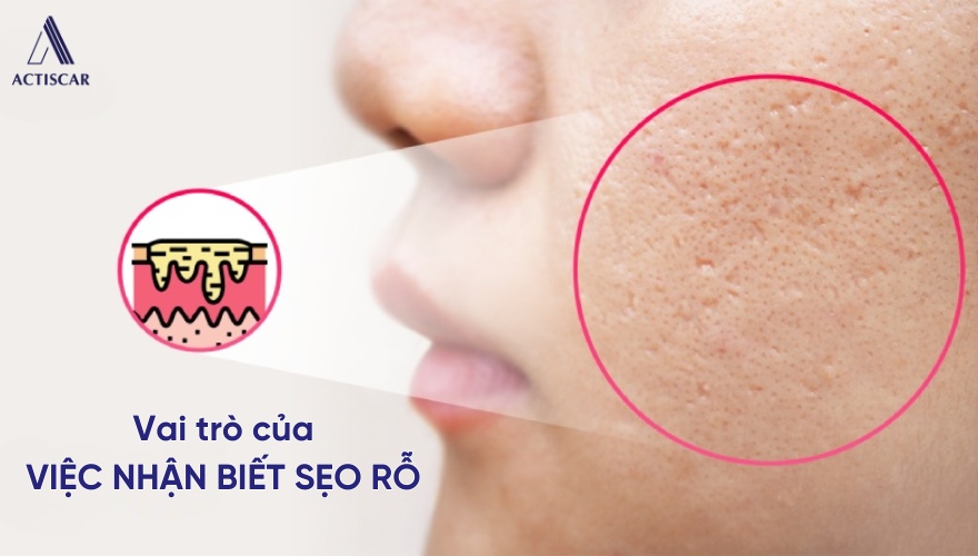 Vai trò của việc nhận diện đúng loại sẹo