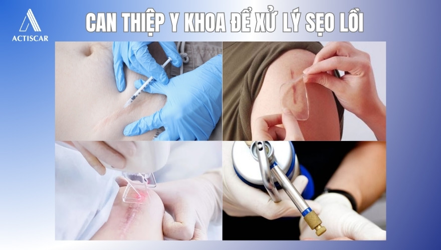 Xử lý sẹo lồi bằng cách can thiệp y khoa