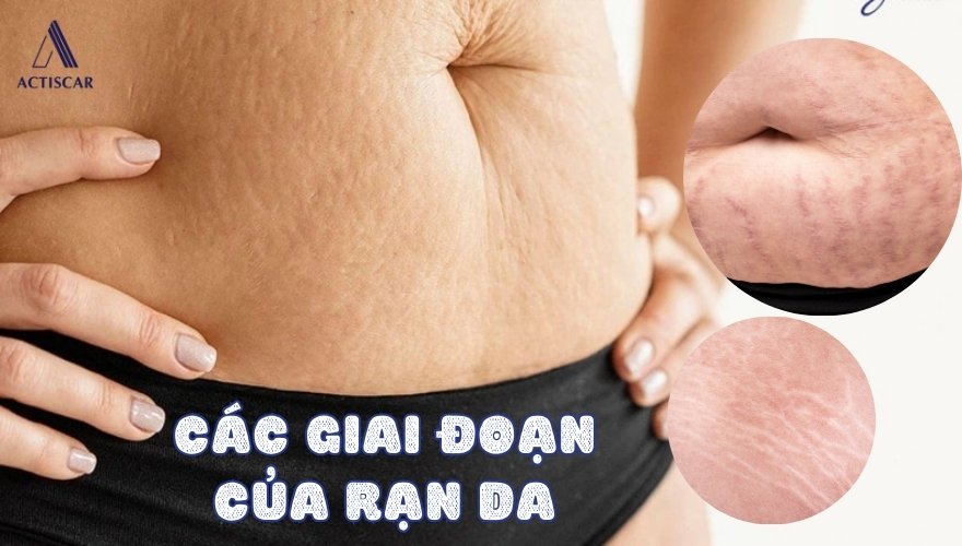 Các giai đoạn của rạn da do béo