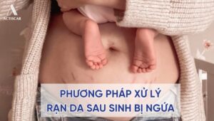 Các phương pháp xử lý vết rạn da bị ngứa sau sinh