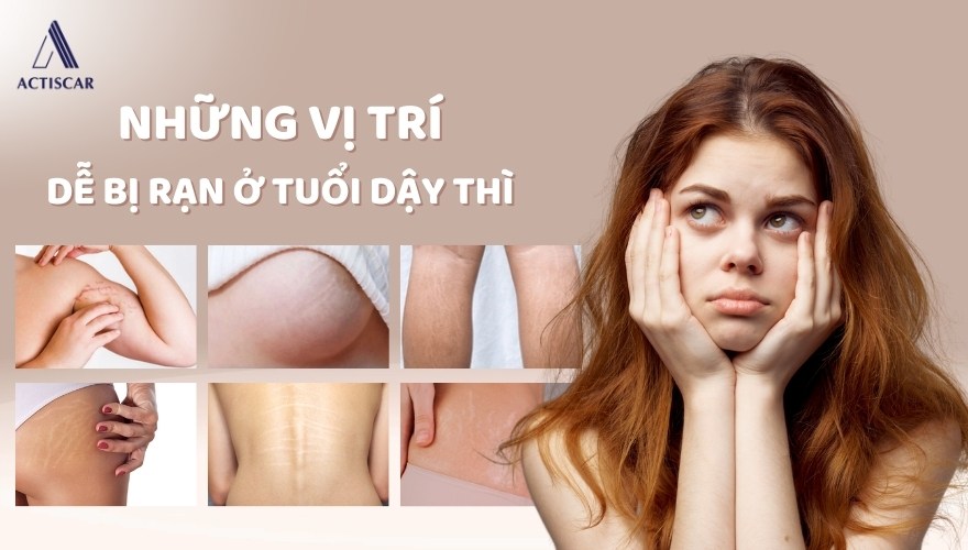 Các vùng da dễ bị rạn ở tuổi dậy thì