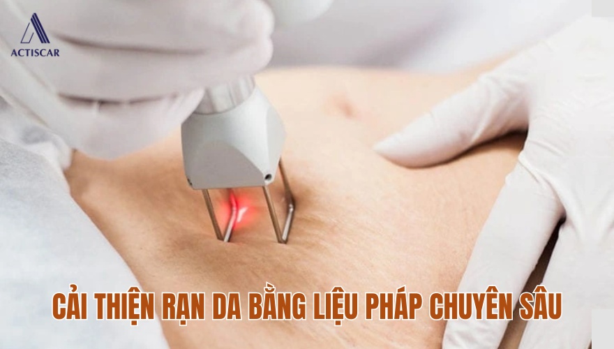 Cách cải thiện rạn da chuyên sâu tại phòng khám