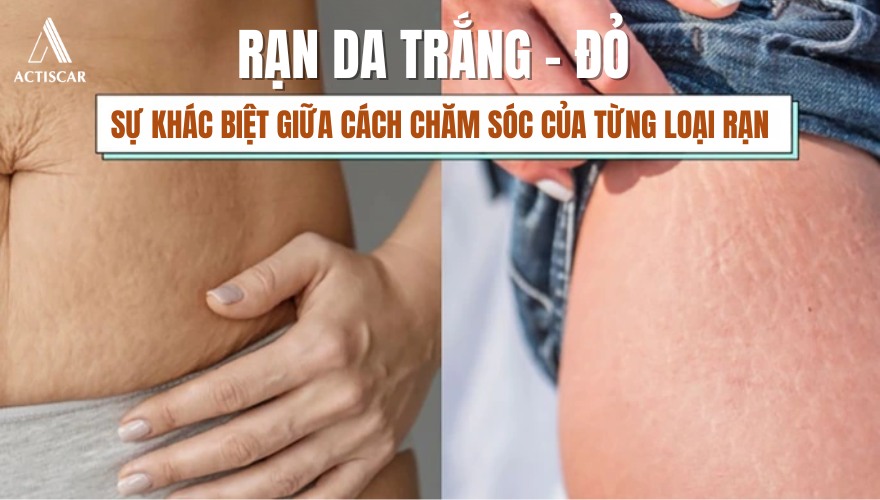 Cách chăm sóc rạn da đỏ và rạn trắng có khác nhau hay không