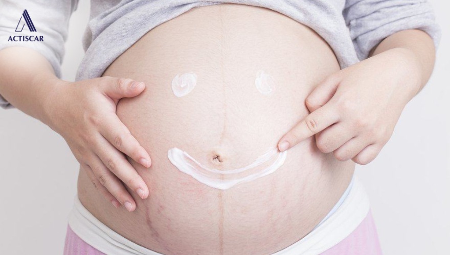 Cách chăm sóc và dưỡng ẩm rạn da tại nhà