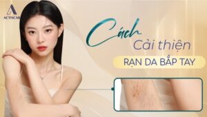 Cách đẻ cải thiện rạn da bắp tay hiệu quả