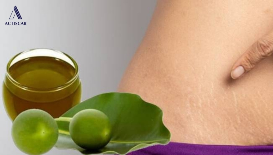 Cách dùng dầu mù u trị rạn da tại nhà