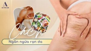 Cách ngăn ngừa rạn da vì tăng cân