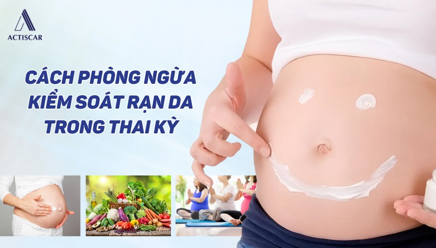 Cách phòng ngừa rạn da am toàn cho bà bầu