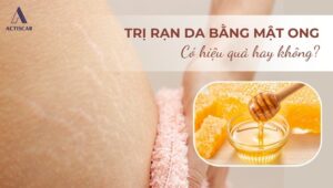 Cách trị rạn da bằng mật ong có hiệu quả không