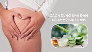 Cách trị rạn da bằng nha đam tại nhà