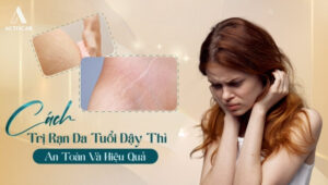 Cách trị rạn da chân ở tuổi dậy thì hiệu quả