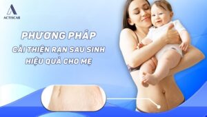 Cách trị rạn da sau sinh lâu năm cho mẹ bỉm