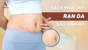 Cách trị rạn da sau sinh mổ hiệu quả