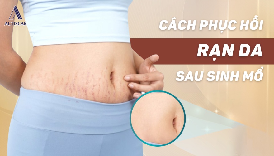 Cách trị rạn da sau sinh mổ hiệu quả