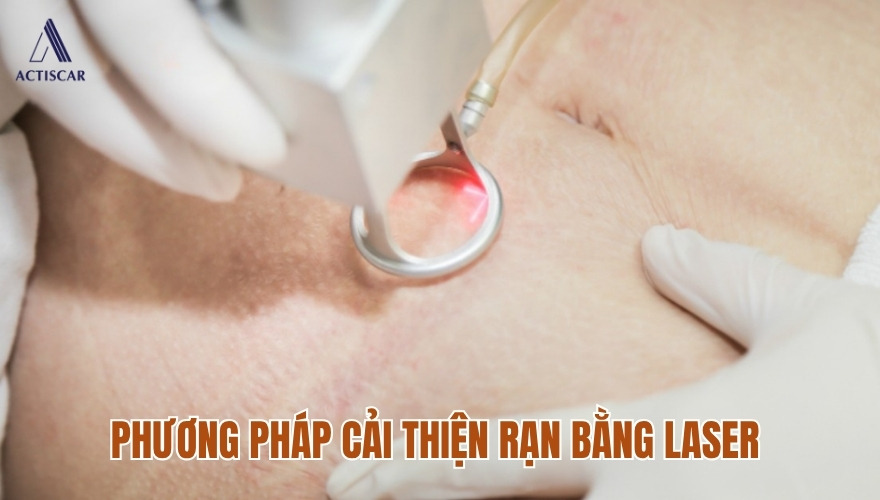 Cách trị rạn da trắng khi tăng cân bằng công nghệ cao