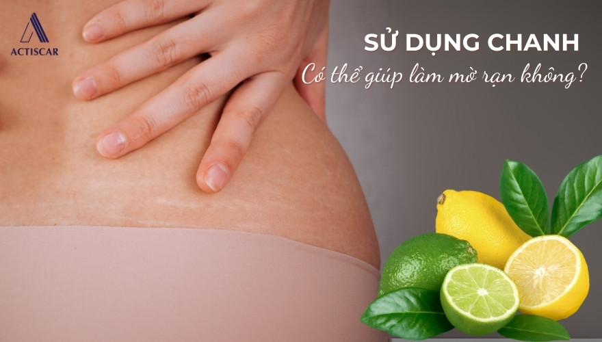 Cách cách trị rạn da bằng chanh có hiệu quả không