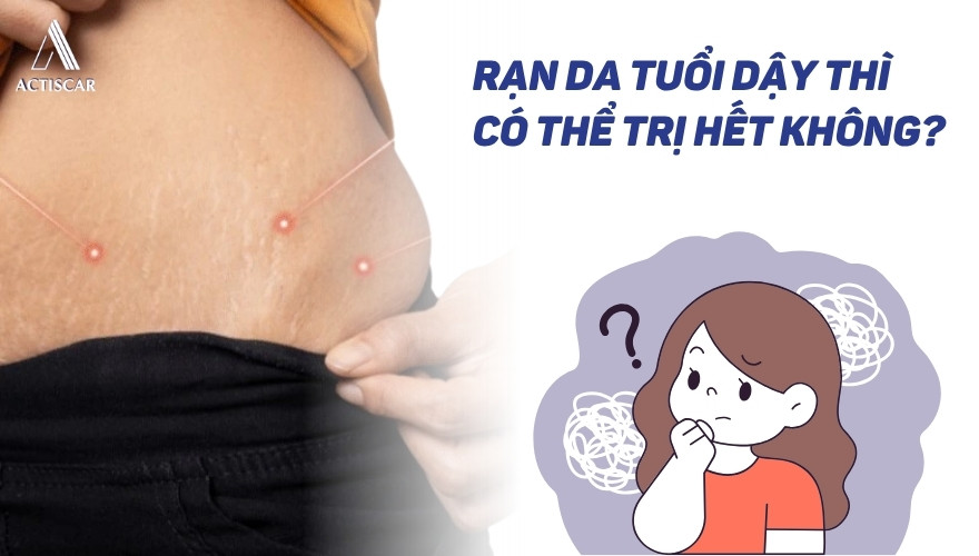 Có thể trị hết rạn da mông tuổi dậy thì không