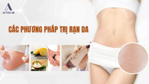 Đâu là các phương pháp trị rạn da an toàn và hiệu quả