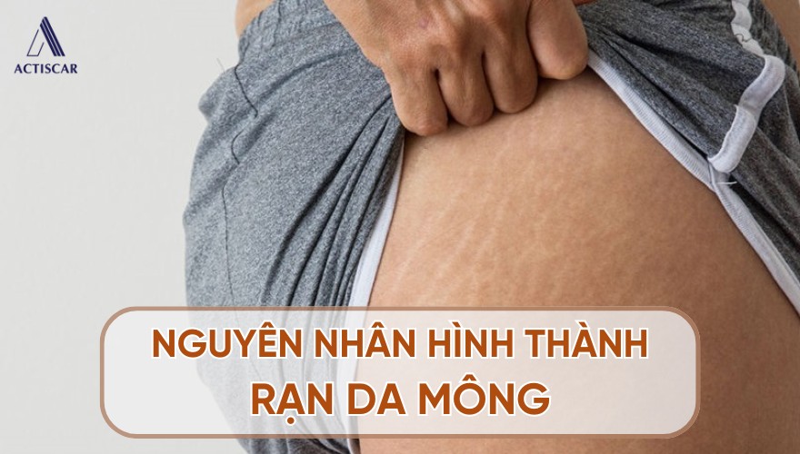 Đâu là nguyên nhân hình thành rạn da mông