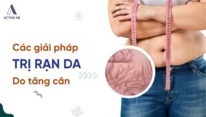 Giải pháp trị rạn da đỏ khi tăng cân cân hiệu quả