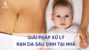 Giải pháp xử lý rạn da sau sinh tại nhà cho mẹ bỉm