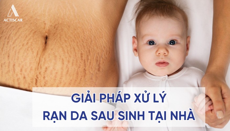Giải pháp xử lý rạn da sau sinh tại nhà cho mẹ bỉm