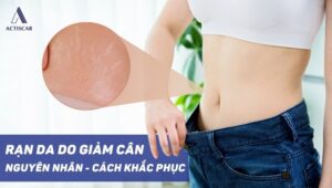 Giảm cân có bị rạn da không? Cách khắc phục hiệu quả