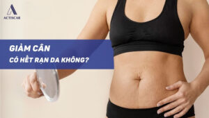 Giảm cân có hết rạn da hay không?
