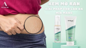 Kem trị rạn da cho người béo - giải pháp mờ rạn an toàn