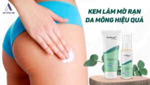 Kem trị rạn da mông chuyên biệt an toàn và hiệu quả