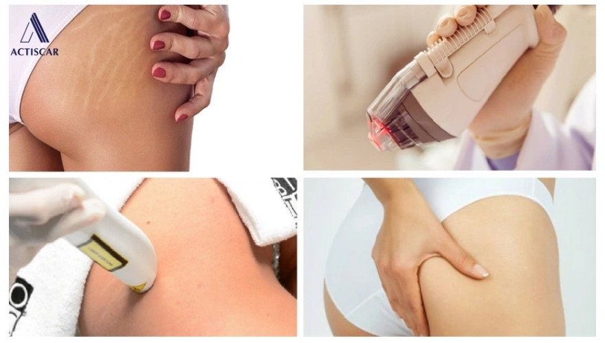 Khi nào nên sử dụng các phương pháp trị rạn đặc trị