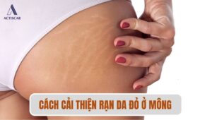 Làm thế nào để cải thiện rạn da ở mông