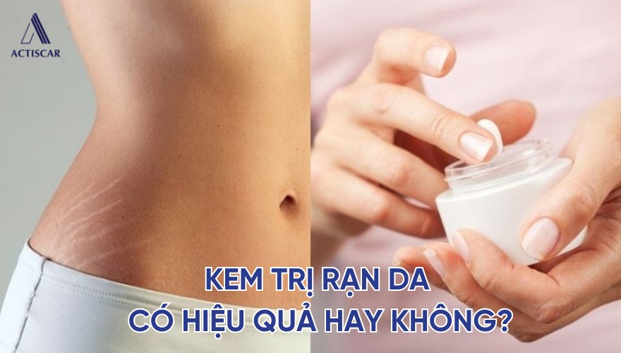 Liệu kem trị rạn da có hiệu quả hay không