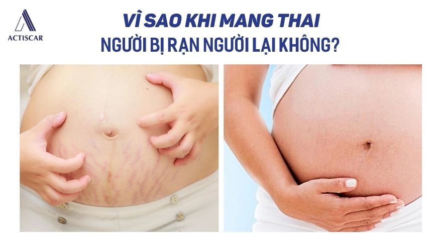Người bị rạn và người không bị rạn khi mang thai
