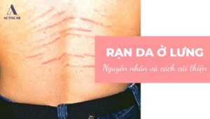Nguyên nhân và cách cải thiện rạn da ở lưng
