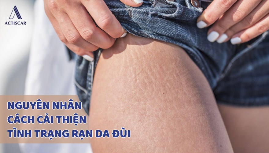 Nguyên nhân và cách cải thiện tình trạng rạn da đùi
