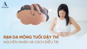 Nguyên nhân và cách điều trị rạn da tuổi dậy thì