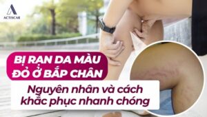 Nguyên nhân và cách khắc phục khi bị rạn da màu đỏ ở bắp chân