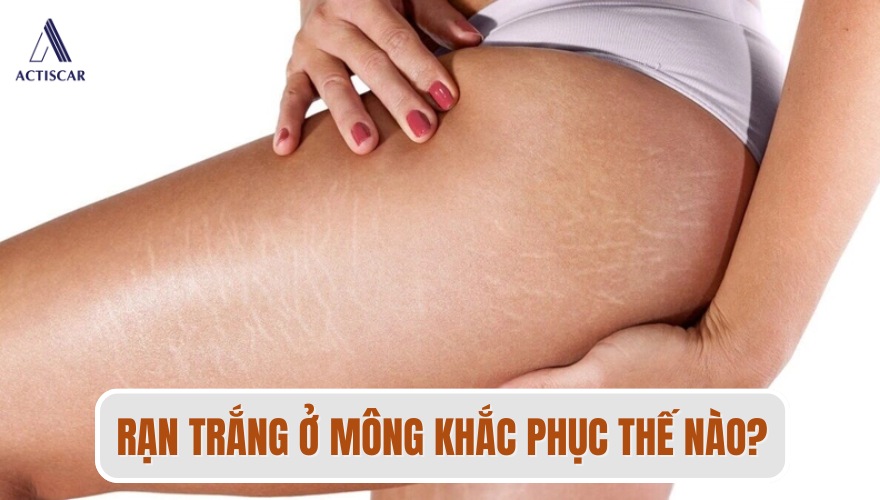 Nguyên nhân và cách khắc phục rạn trắng ở mông