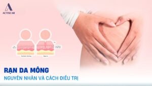 Nguyên nhân và cách trị rạn da mông