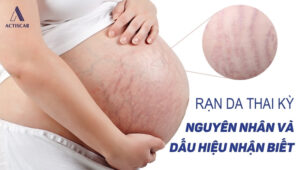 Nguyên nhân và dấu hiệu rạn da khi mang thai