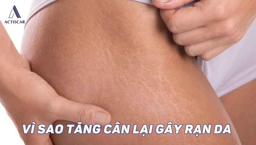 Nguyên nhân vì sao tăng cân lại gây rạn