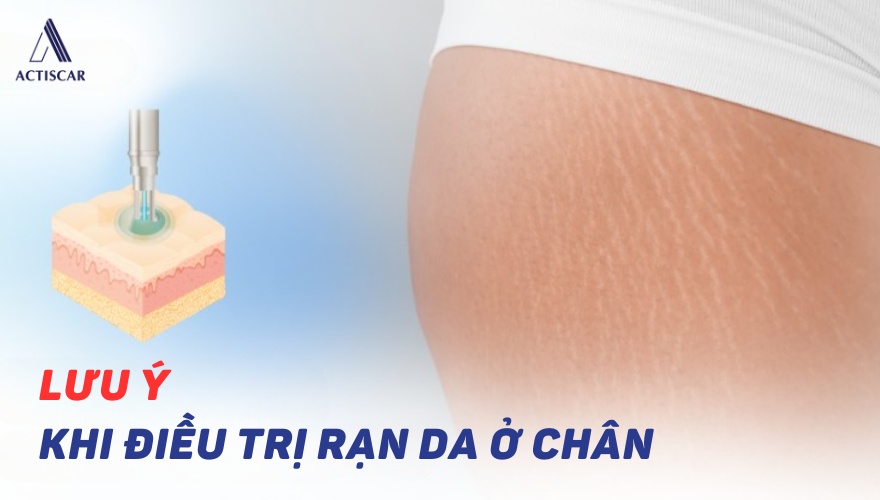 Những lưu ý khi điều trị rạn da ở chân