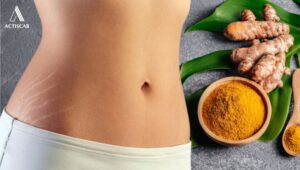 Phương pháp chữa rạn da sau sinh bằng nghệ