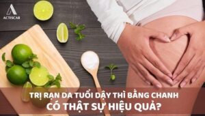 Phương pháp trị rạn da tuổi dậy thì bằng chanh