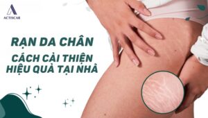 Rạn da chân, nguyên nhân và cách khắc phục