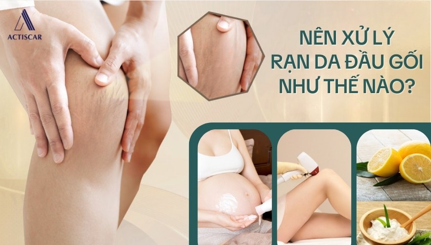 Rạn da đầu gối nên xử lý như thế nào