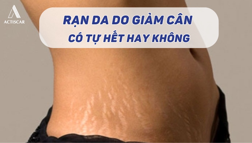 Rạn da do giảm cân có tự hết không