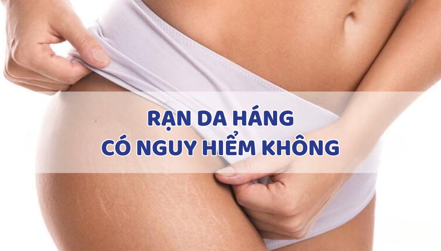 Rạn da háng có gây nguy hiểm hay không