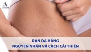 Rạn da háng nguyên nhân và cách xử lý
